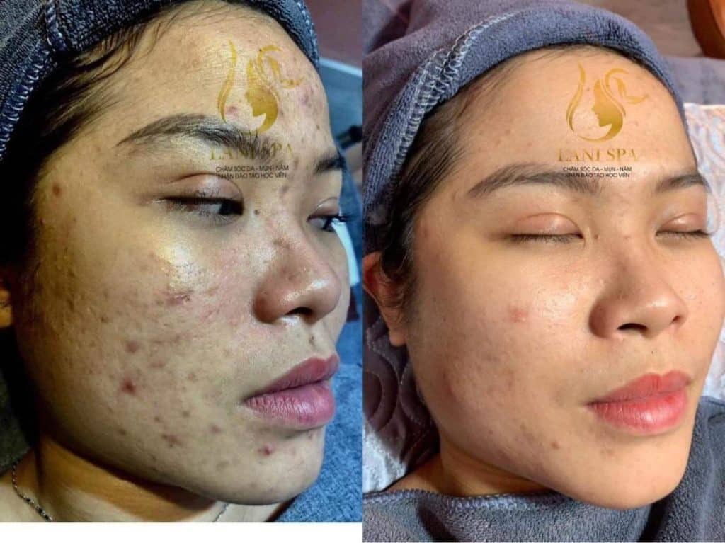 Lani Spa quận tân phú