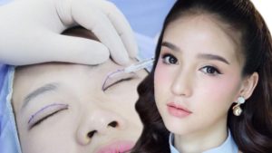 Nhấn mí mắt