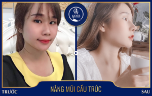 Dịch Vụ Nâng Mũi tại TpHCM