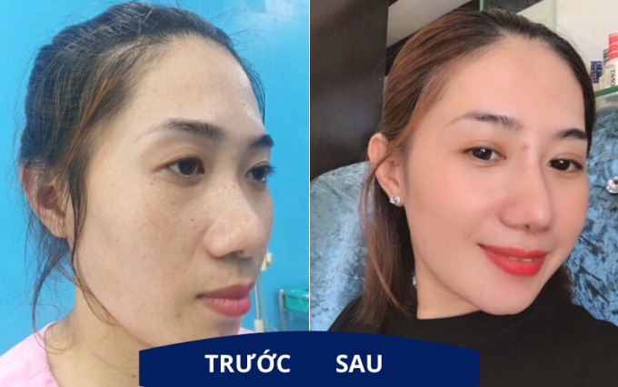 nâng mũi ở đâu đẹp tại tphcm