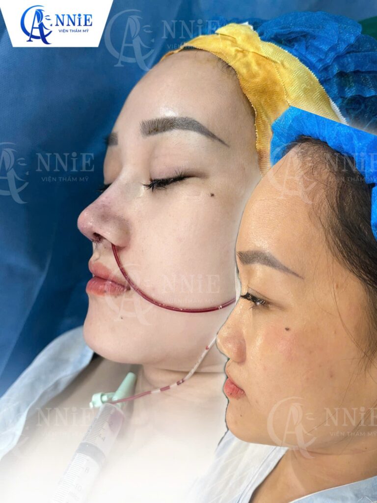 Dịch vụ nâng mũi tại Annie-1