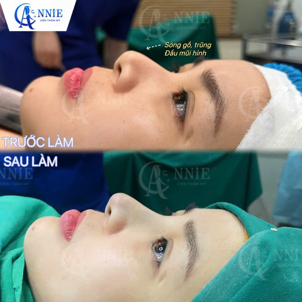 Dịch vụ nâng mũi tại Annie-2