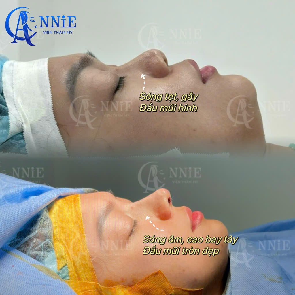 Dịch vụ nâng mũi tại Annie-3
