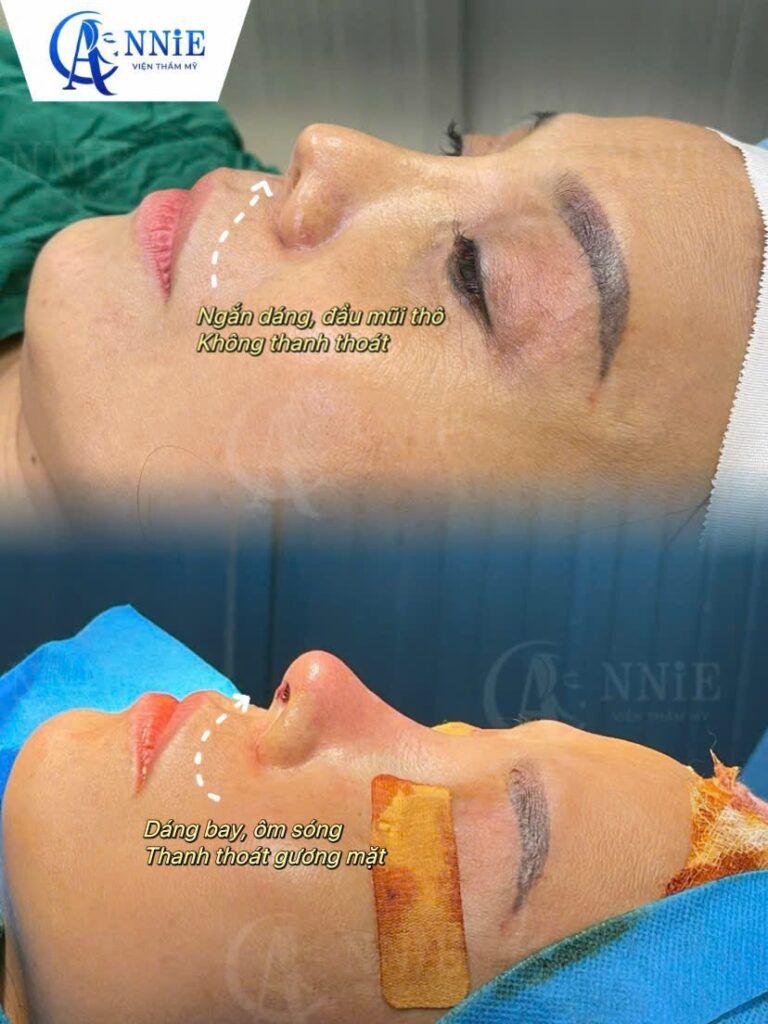 Dịch vụ nâng mũi tại Annie-4