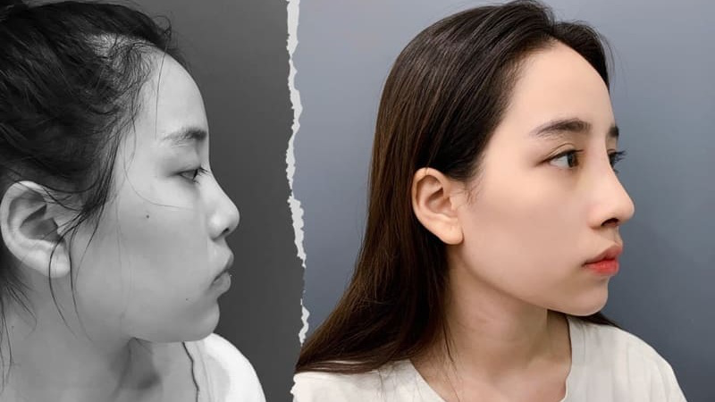 Nâng mũi L-line là gì