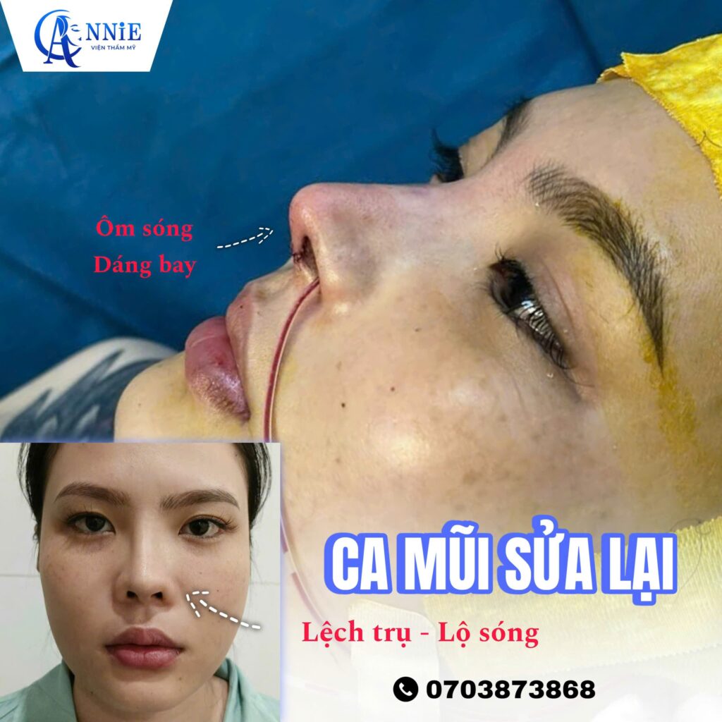 Sửa mũi nâng tại Annie